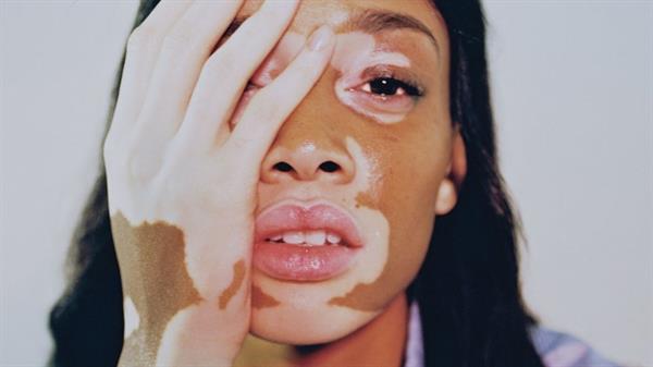 Winnie Harlow